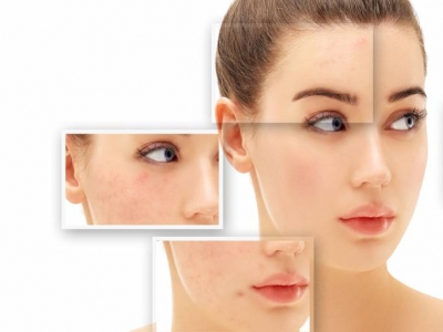 Consejos para quitar las marcas de acné que no sabías y productos efectivos